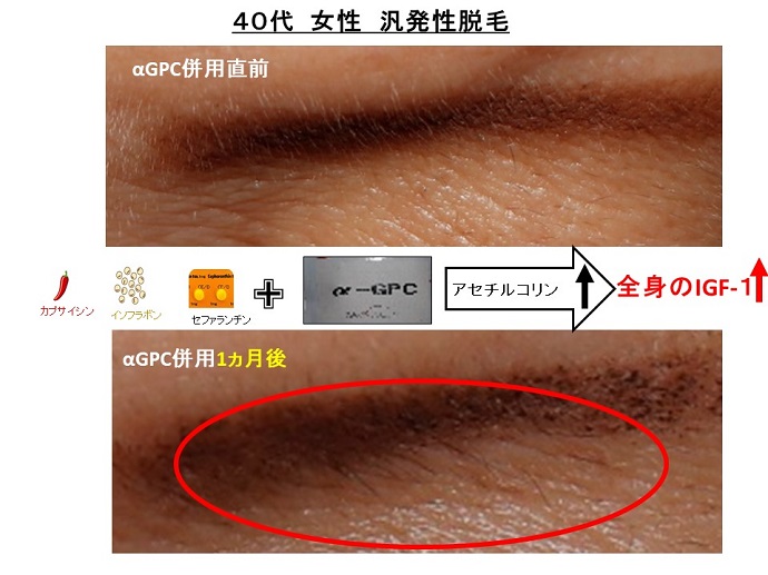 円形脱毛症　病院